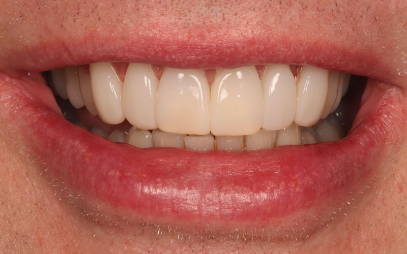 After composite bonding at Tower Dental Blackpool