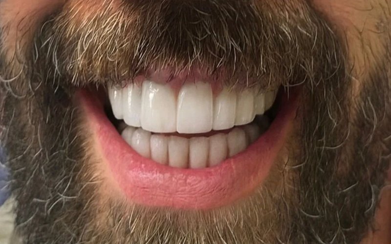 After Invisalign at Tower Dental Blackpool