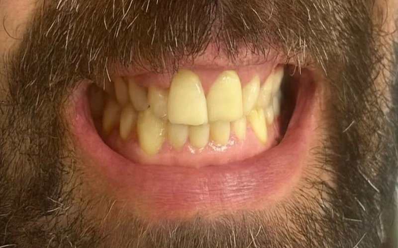 Before Invisalign at Tower Dental Blackpool