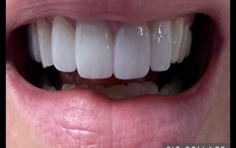 After veneers at Tower Dental Blackpool