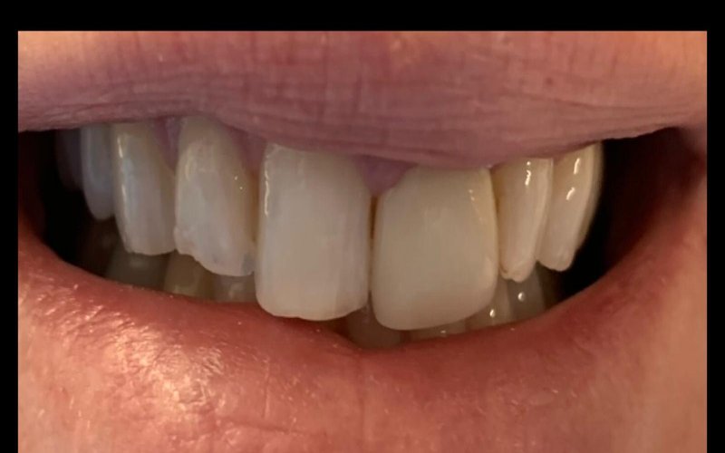 Before veneers at Tower Dental Blackpool